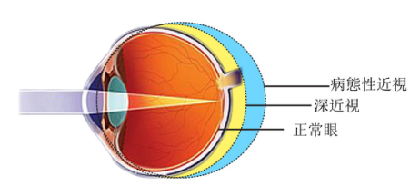阿托品,眼药水,防止,儿童,近视,加深,近视,,