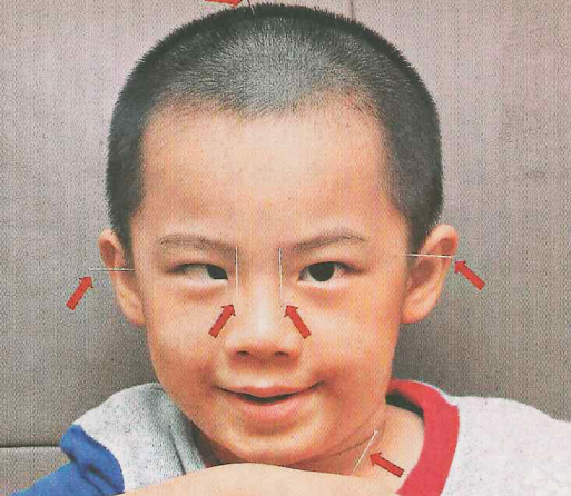 孩子,喜欢,歪头,看,东西,可能,是,斜视,在,