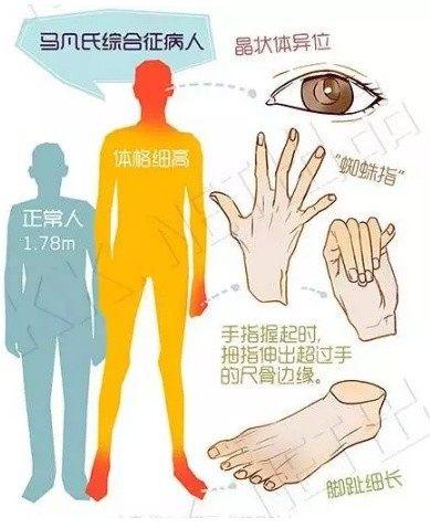马凡氏,综合征,的,症状,有,哪些,什么,是,