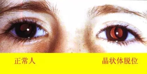 马凡氏,综合征,的,症状,有,哪些,什么,是,