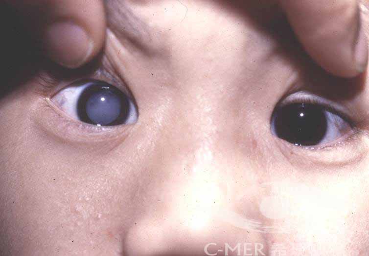 小儿,先天性,白内障,的,这些,危害,你,了解,吗,