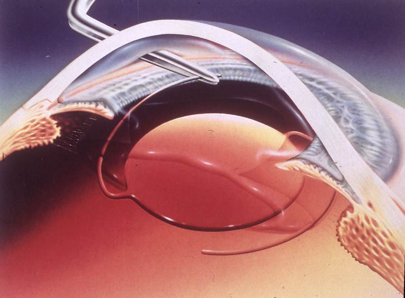 小儿,先天性,白内障,的,这些,危害,你,了解,吗,