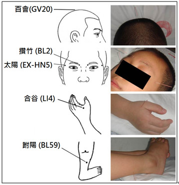 中西,医药,合璧,儿童,弱视,可采用,针灸,辅助,